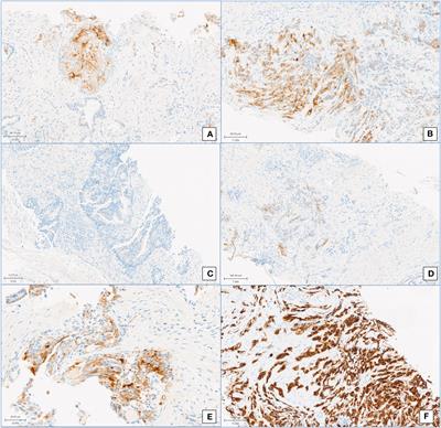 Immunohistochemistry analysis of PSMA expression at prostatic biopsy in high-risk prostate cancer: potential implications for PSMA-PET patient selection